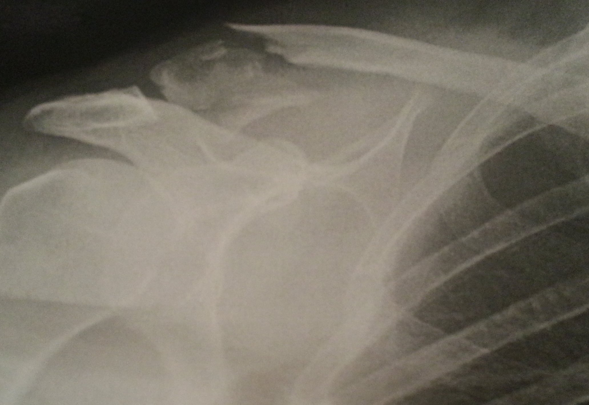 Being told it's bowel cancer when you've already got a broken collarbone seems a bit harsh