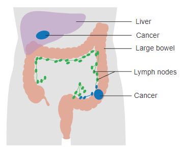 Dukes Stage D bowel cancer, the cancer has metastasized