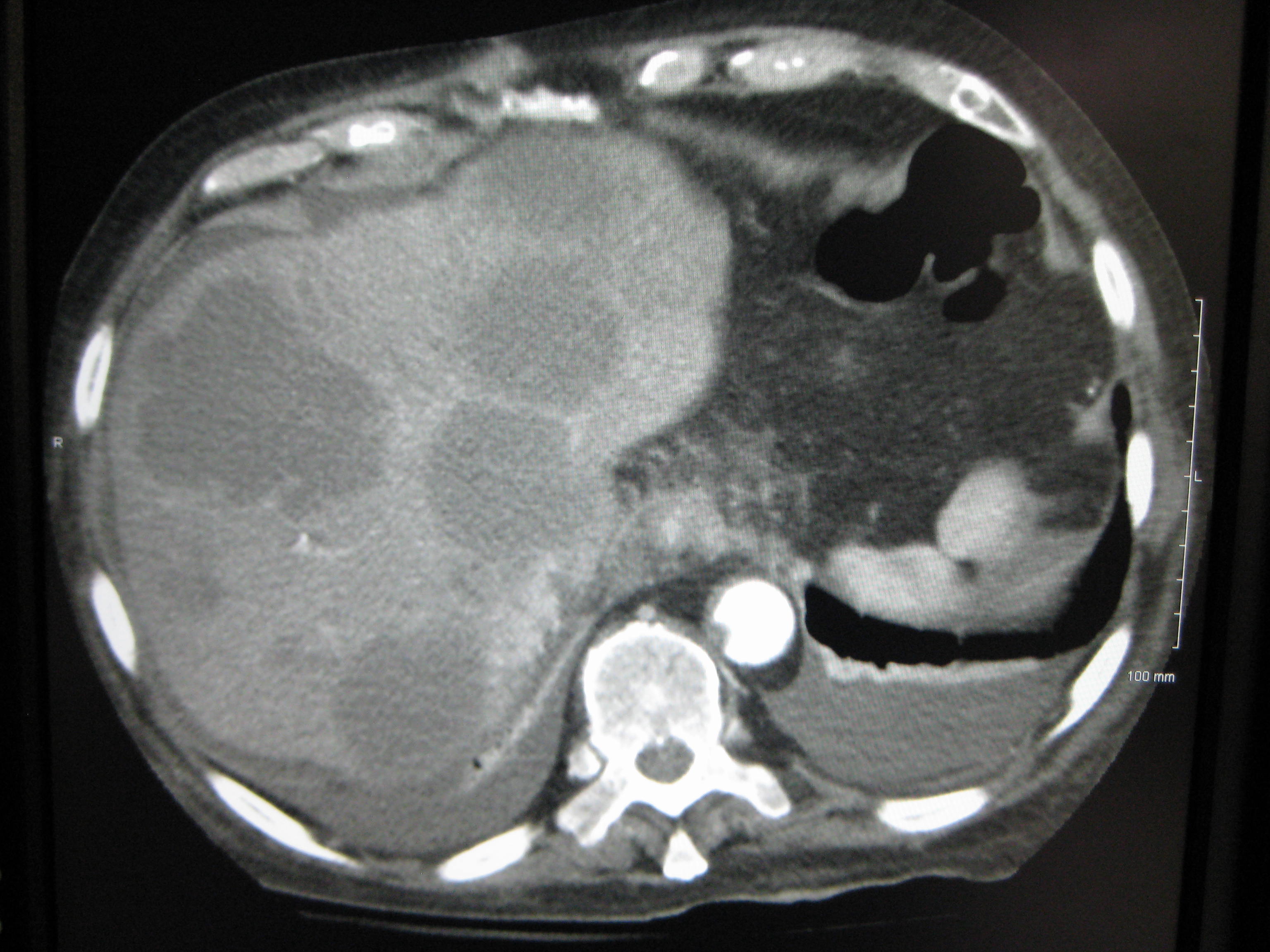 Liver mets on a CT Scan